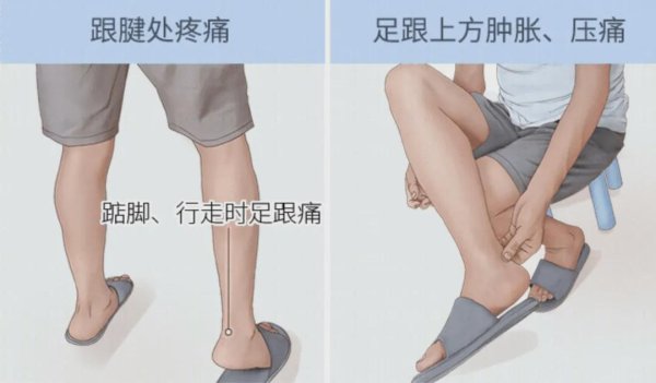长沙股票配资平台 一走路就脚后跟疼？小心是跟腱在 “报警”！
